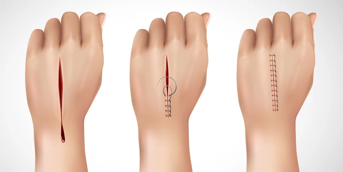 Cover Image for Does Urgent Care Do Stitches? What to Expect at Pronto Urgent Care Fort Lauderdale